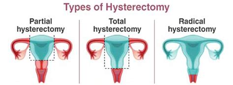 hysterectomy dr natalia novikova cape town gynaecologist
