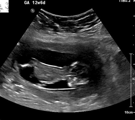 fetal echo babycenter