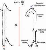 Pulse Wave Velocity Aortic Figure Heartasia Bmj sketch template