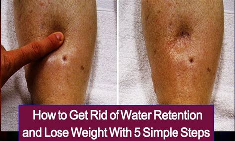 How To Get Rid Of Water Retention And Lose Weight With 5