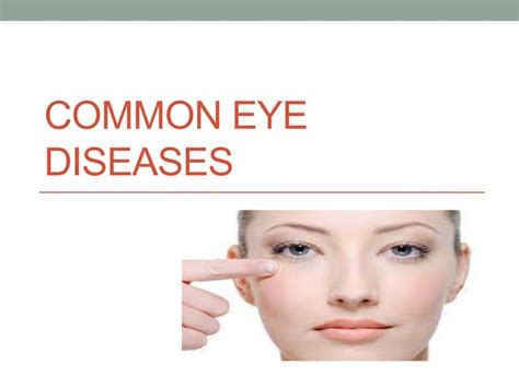 Common Eye Diseases Ppt