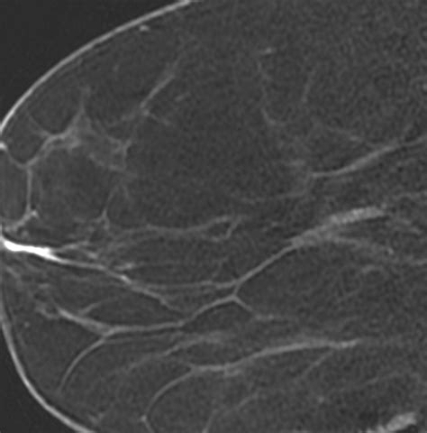 ductal carcinoma in situ of the breast mr imaging findings with