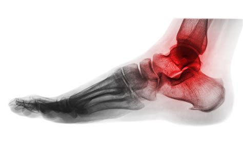 hindfoot arthritis south west foot surgery