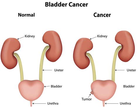 bladder tumor symptoms  pictures