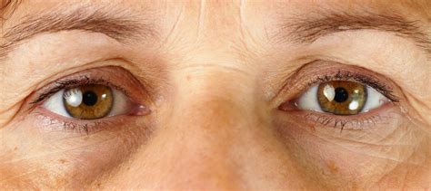 eye wrinkles  surgery tca peel wont work scary symptoms