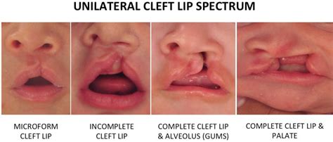 Pediatric Cleft Lip