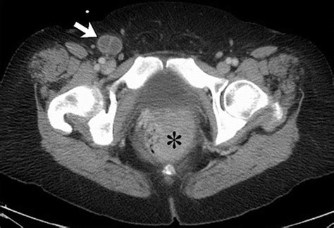 Diagnostic Performance Of Multitarget Stool Dna And Ct Colonography For