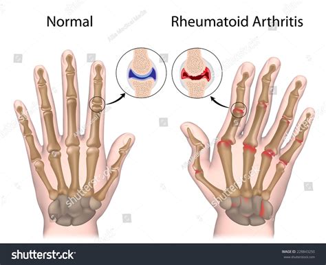 Rheumatoid Arthritis Hand Stock Illustration 228843250