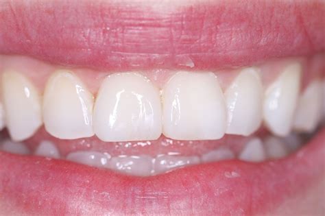 tandarts opwijk mooie tanden check  smile
