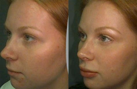Facial Implants Before And After Nude Moives