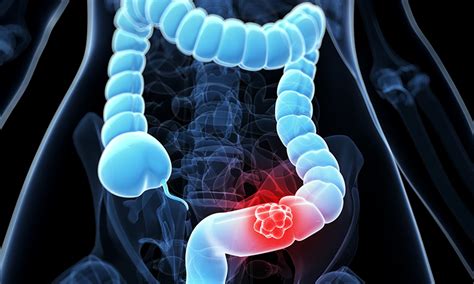 Colorectal Cancer Causes Staging Symptoms And Treatment Kayawell