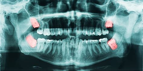 Impacted Wisdom Tooth Dentist Recommended Treatment