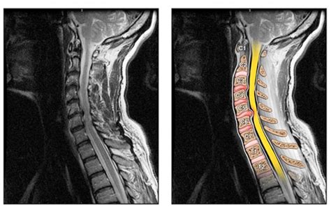 Cervical Spine Disease Treated In Baltimore At Mercy