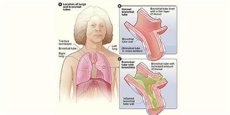 acute bronchitis nursing care plan and management rnpedia