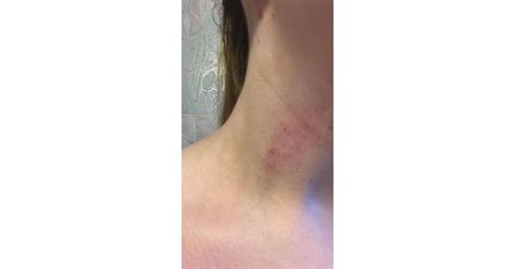 before how to get rid of a hickey popsugar beauty photo 2