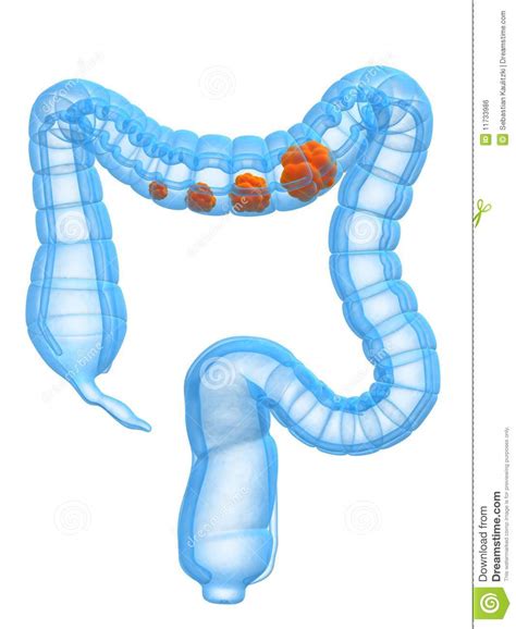 Colon Cancer Stages Royalty Free Stock Image Image 11733986