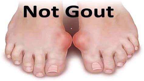gout   big toe joint goutinfoclubcom