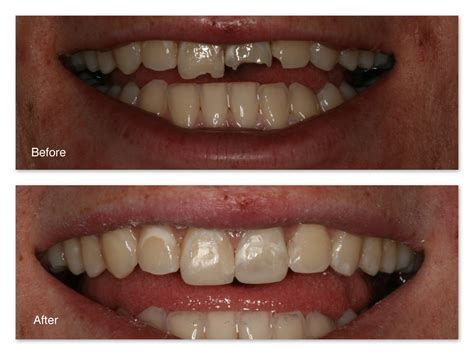 Tooth Colored Fillings Gallery Dr Jack M Hosner D D S