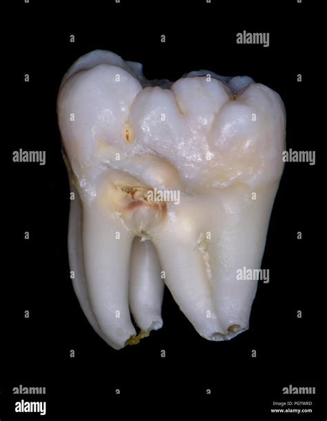 wisdom tooth  left molar extra large  tooth   fusion gemination