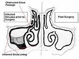 Sinus Sinusitis Fess Endoskopi Endoscopic Mengobati Bagaimana Polip Operasi Bedah Fungsional Alternatif Pengobatan Melia Terapi Site Menggunakan Dilakukan Operasinya Sebut sketch template