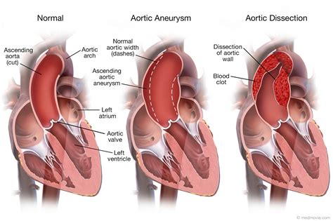 aortic aneurysm  aortic dissection medmoviecom