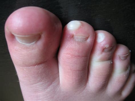 How To Get Rid Of A Corn On The Bottom Of The Foot Feet Blisters From