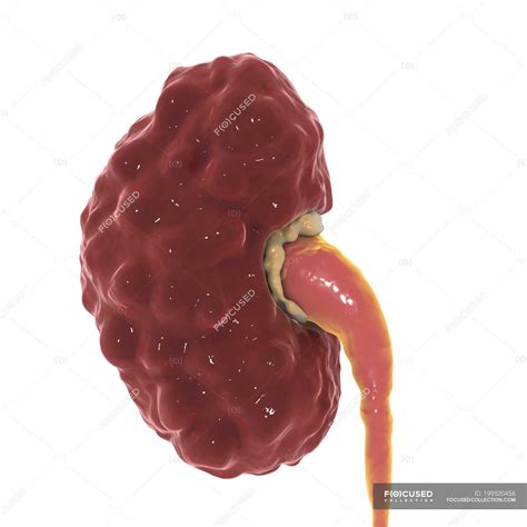 chronic pyelonephritis  kidney digital illustration dilated