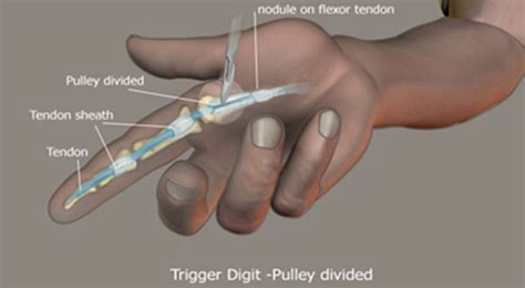 tendon sheath injections motion  medicine