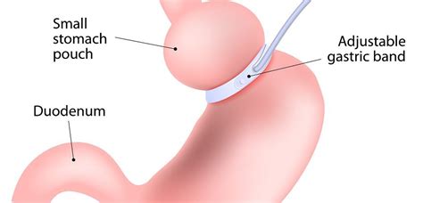 Gastric Banding Is A Weight Loss Band Right For You