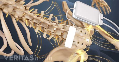 rechargeable spinal cord stimulators  chronic pain