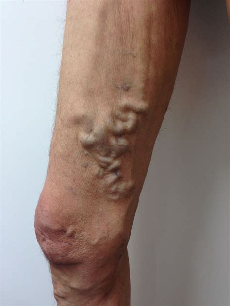 Varicose Vein Results And Post Treatment Photos — The Leg