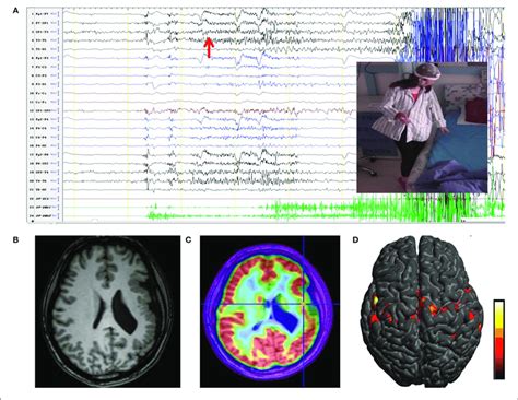 ictal eeg originated   left unilateral pmg   ictal