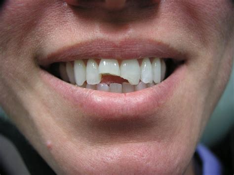 crowns advance dental pc dentist birmingham al