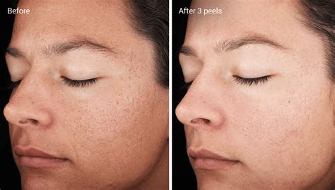 chemical peels  acne scars efficacy   afters  home
