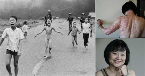 Vietnam War Napalm Girl Kim Phuc Gets Laser Surgery To Reduce Pain And