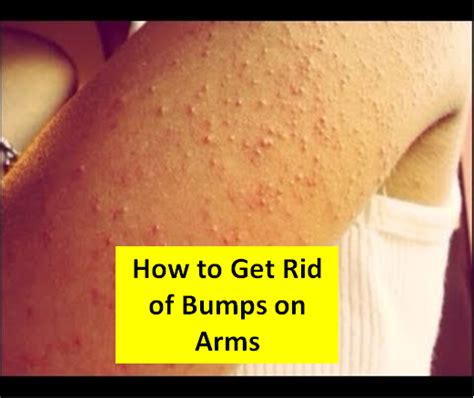 Get Rid Of Bumps Back Of Arms Get Rid Of Bumps