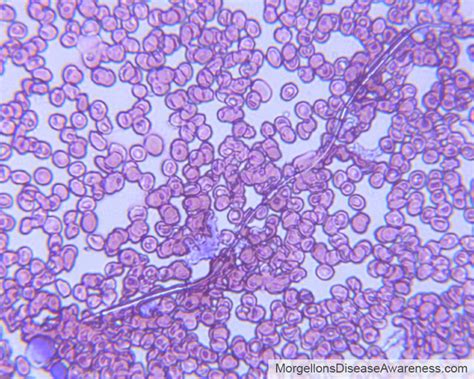 morgellons disease awareness  blood microscopy