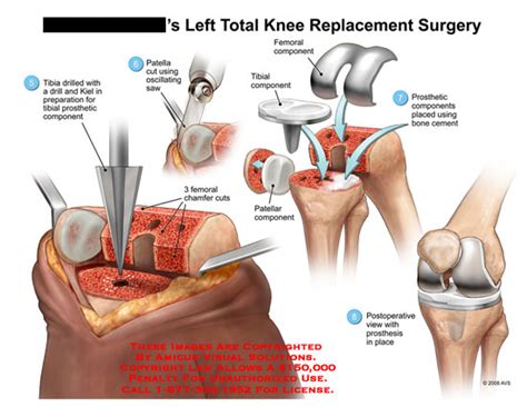 Left Total Knee Replacement Surgery