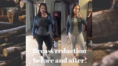breast reduction   pictures youtube