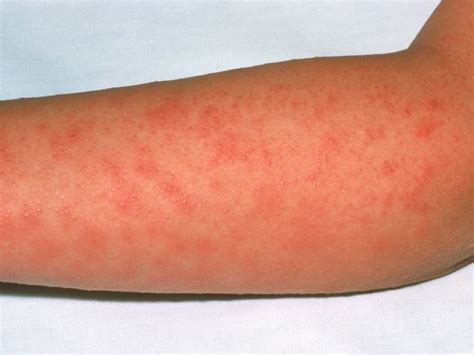 New Strep A Strain Linked To Scarlet Fever And Sepsis