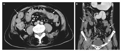 Adenocarcinoma Stage 4 Adenocarcinoma