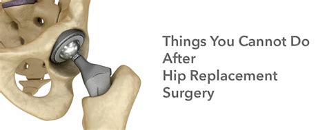 Things You Can’t Do After Hip Replacement Surgery Hip