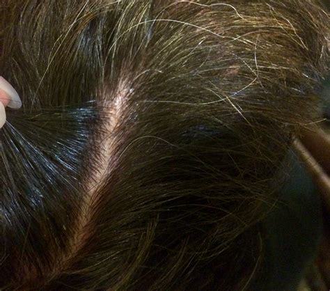 flaky scalp  treatment   revelation figaro london