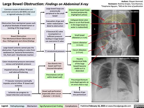 large bowel obstruction findings  abdominal  ray calgary guide