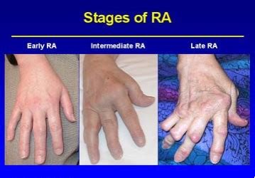 rheumatoid arthritis physiopedia