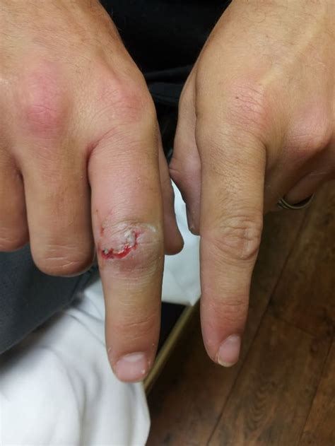 broken finger broken finger swollen hands finger