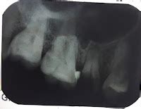 pengalaman perawatan saluran akar gigi psa  bpjs