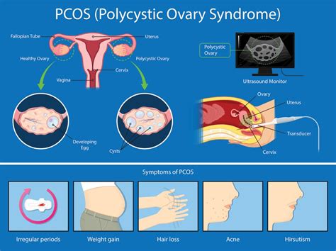pcos symptoms causes diagnosis and treatments