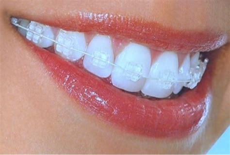 types  braces