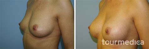 teardrop breast augmentation before and after
